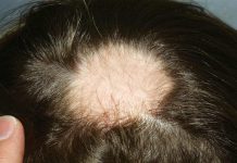 Alopecia Areata – Hair Loss Causes Alopecia areata